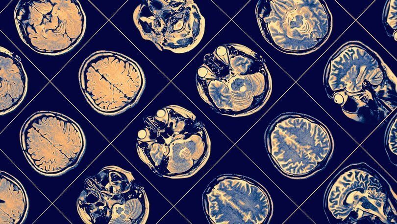 beynini amipler yedi